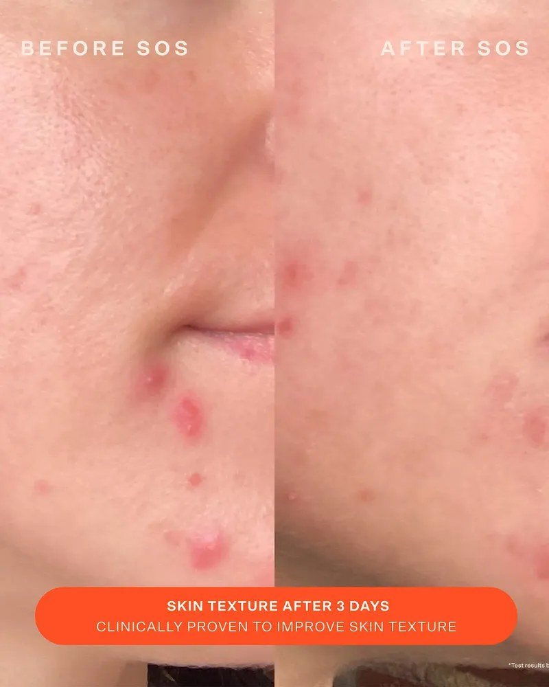 SOS Recovery Cream